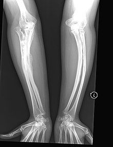osteogenosis.jpg